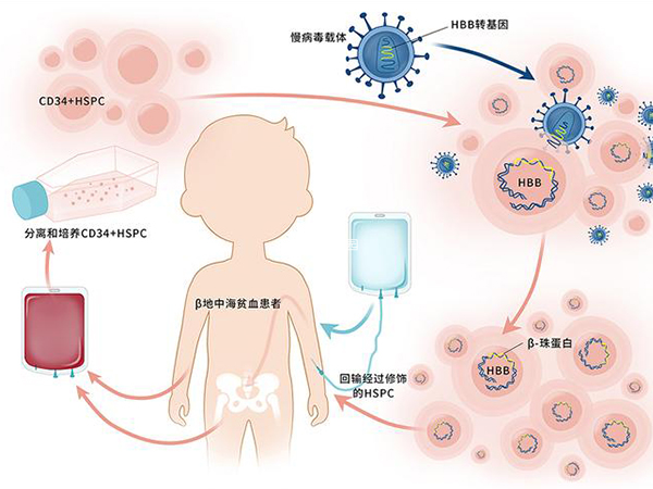 地贫精准治疗突破传统，最新疗法问世